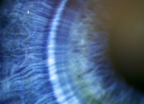 Douleur oculaire